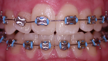 fixed braces in use